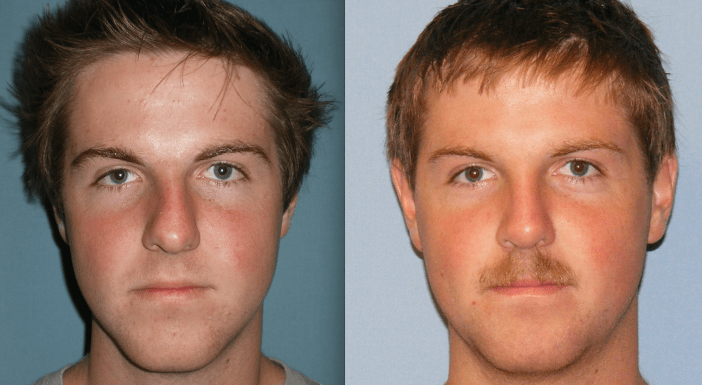 Rhinoplasty Before & After