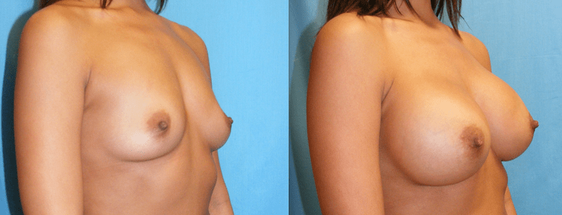 Breast Augmentation Before and After Photo