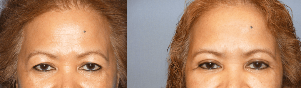 Before and After Eyelifts