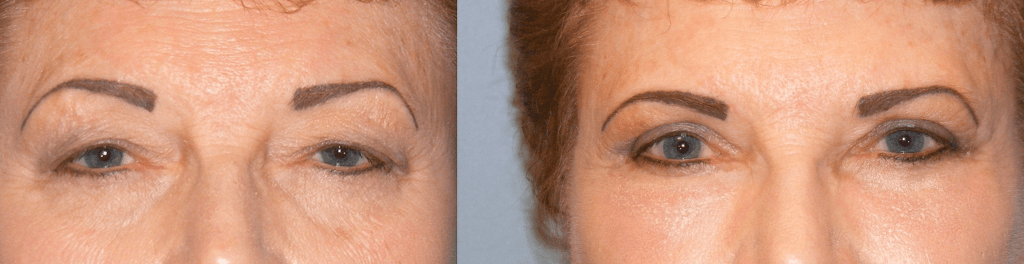 Before and After Eyelifts