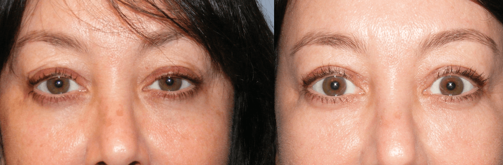Before and After Eyelifts