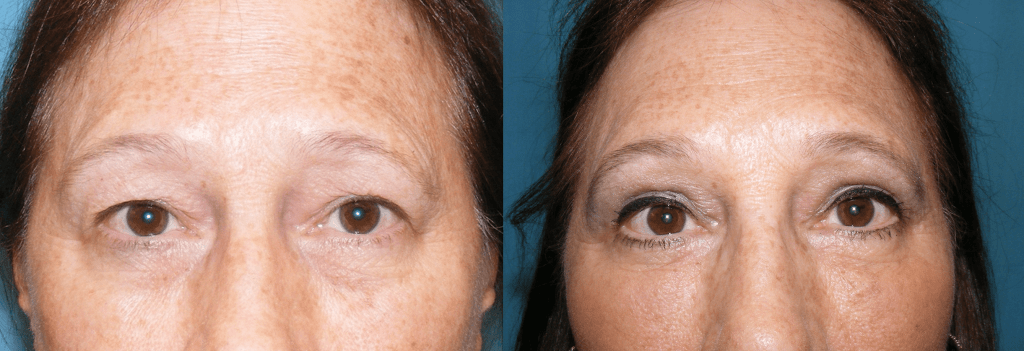 Before and After Eyelifts