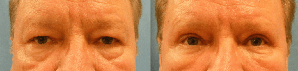 Before and After Eyelifts