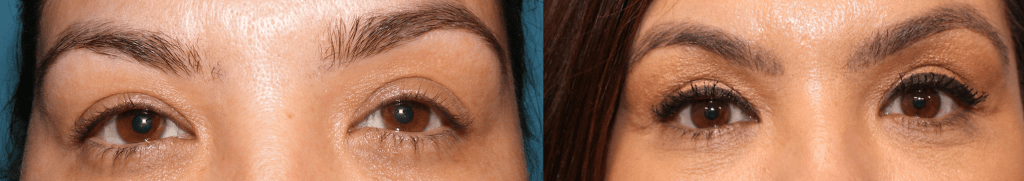 Before and After Eyelifts