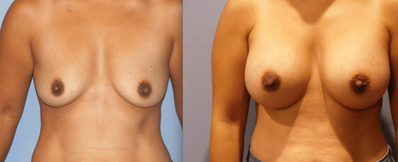 Breast Augmentation Before and After Photo