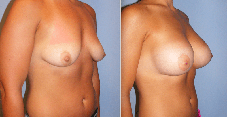 Breast Augmentation Before and After Photo