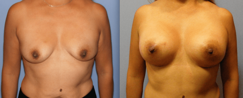 Breast Augmentation Before and After Photo