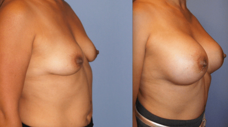 Breast Augmentation Before and After Photo