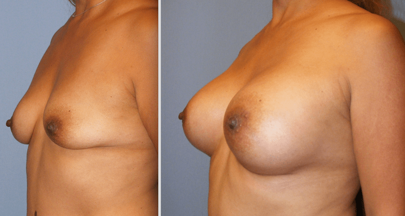 Breast Augmentation Before and After Photo