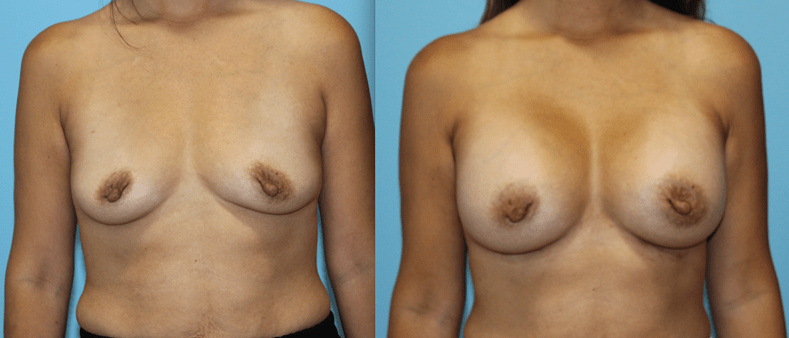 Breast Augmentation Before and After Photo