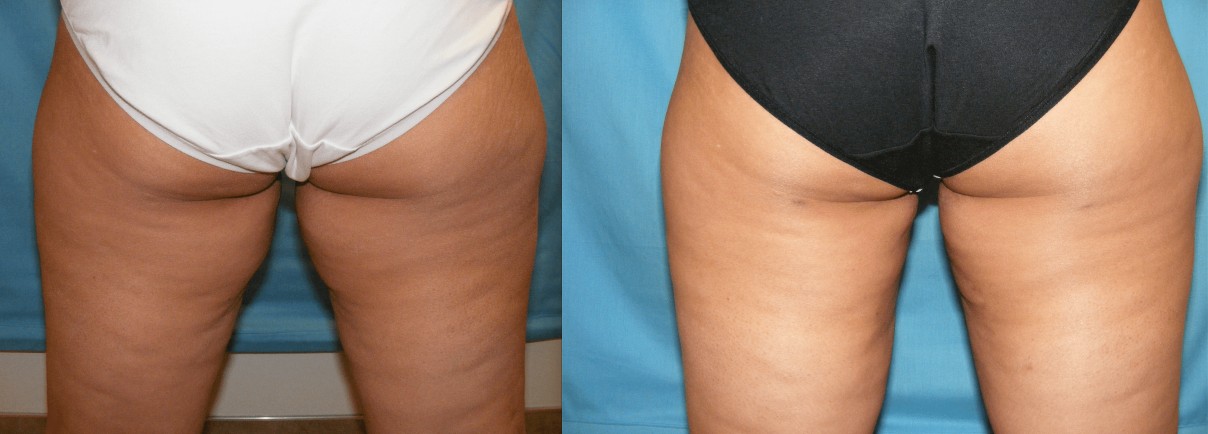 Before & After Liposuction