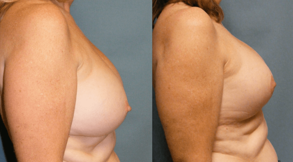 Breast Augmentation Before and After Photo