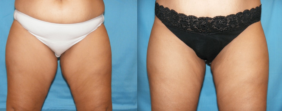 Before & After Liposuction