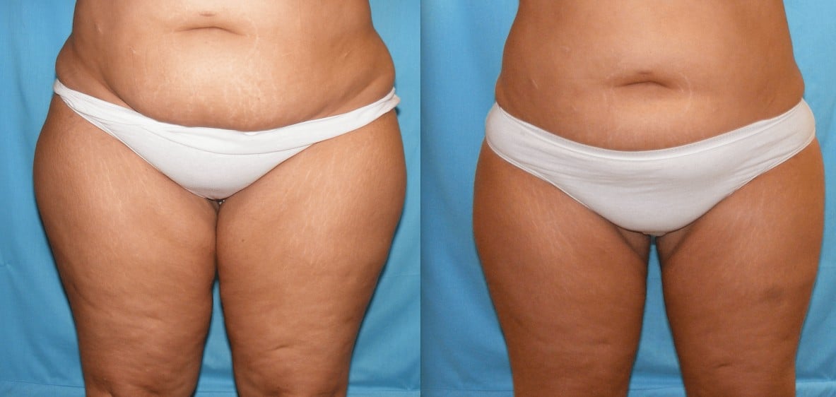 Before & After Liposuction