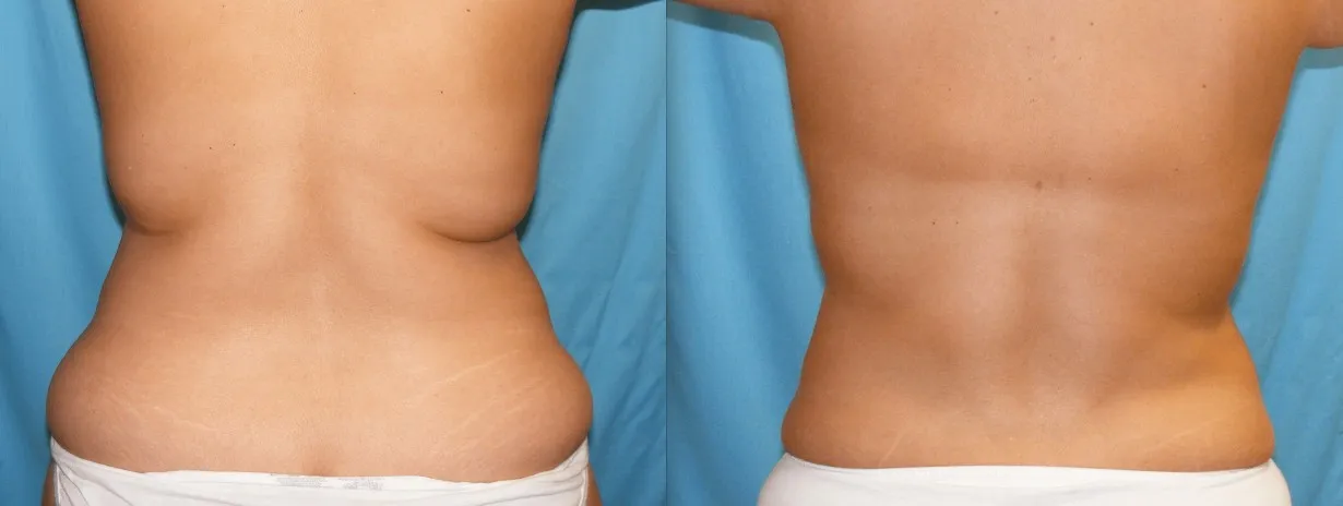Before & After Liposuction