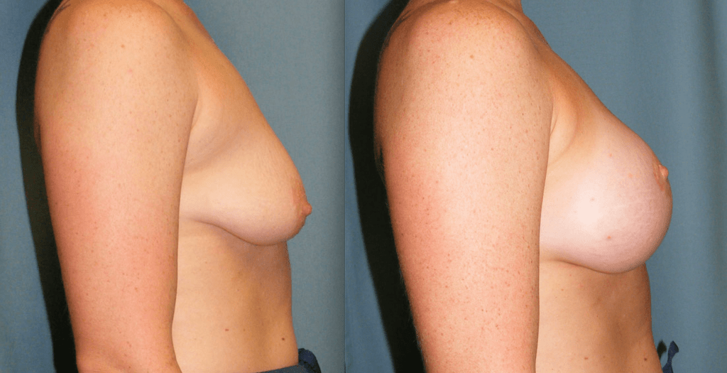Breast Augmentation Before and After Photo