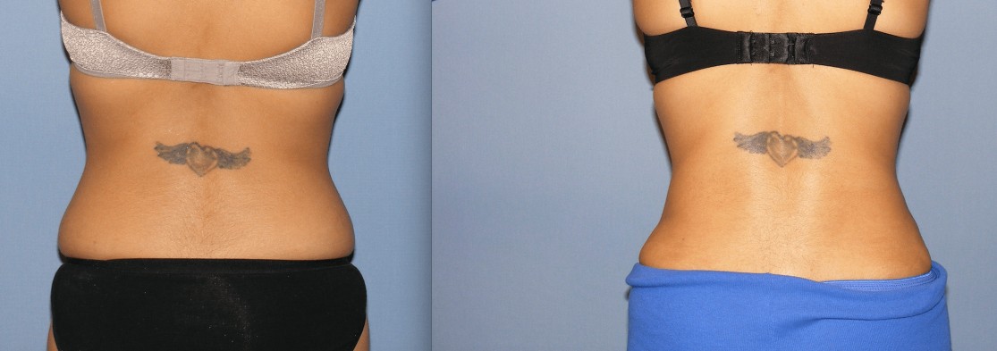 Before & After Liposuction