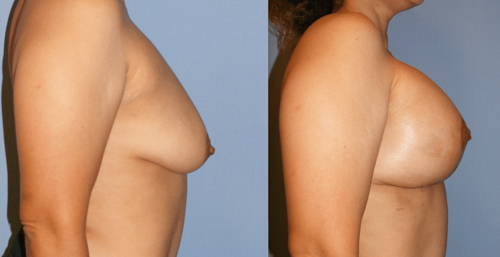 Breast Augmentation Before and After Photo