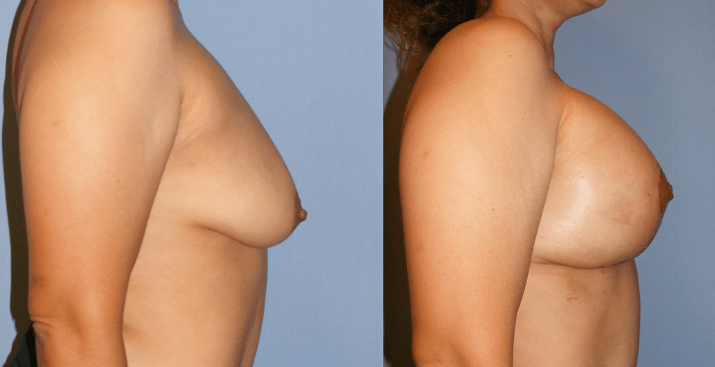 Breast Augmentation Before and After Photo