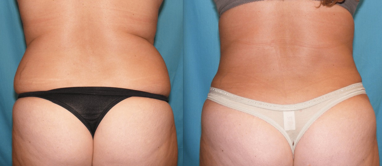 Before & After Liposuction