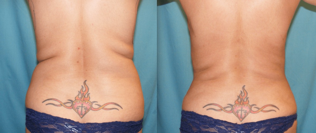 Before & After Liposuction