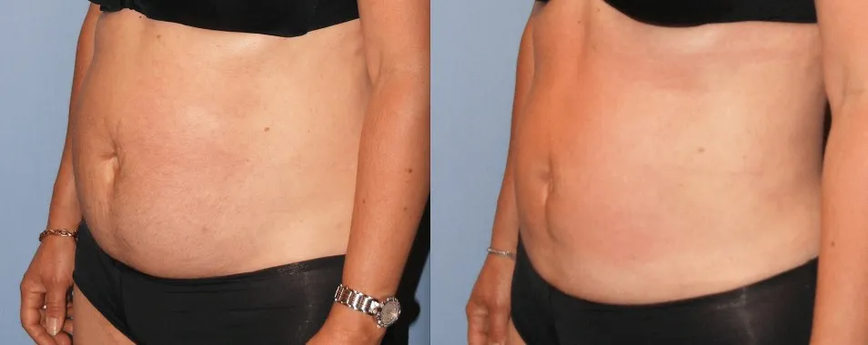 Before & After Liposuction
