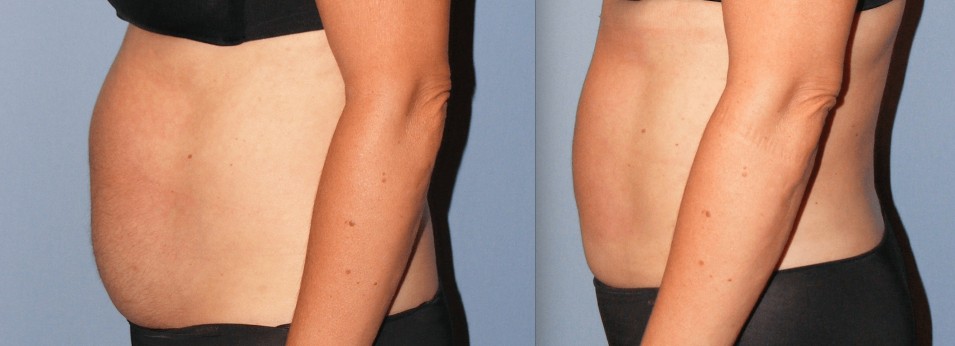 Before & After Liposuction