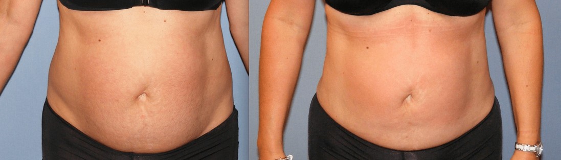 Before & After Liposuction