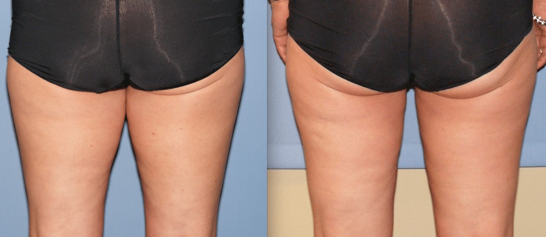 Before & After Liposuction
