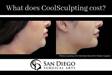 What Does CoolSculpting Cost | San Diego Surgical Arts