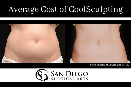 What is CoolSculpting®?, CoolSculpting