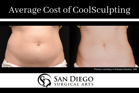 The Average Cost of CoolSculpting | San Diego Surgical Arts